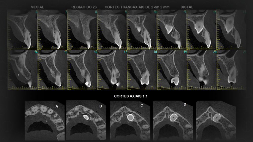 Tomografia Convencional e Tomografia Cone Beam