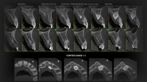 Tomografia Convencional e Tomografia Cone Beam
