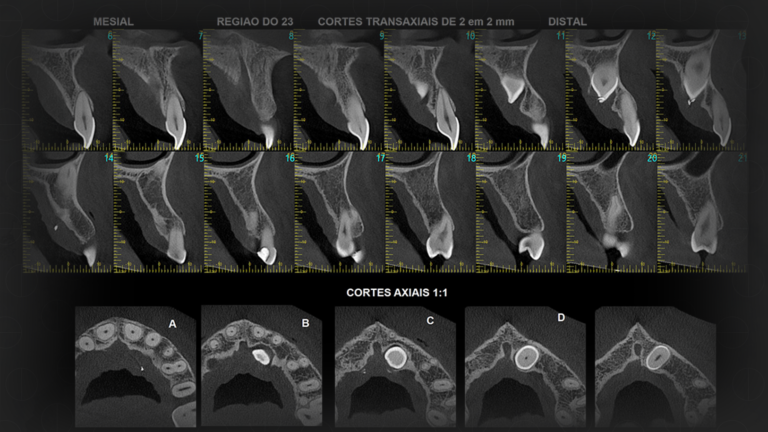 Tomografia Convencional e Tomografia Cone Beam